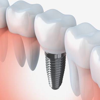 Zahnimplantate: so fest wie eigene Zähne